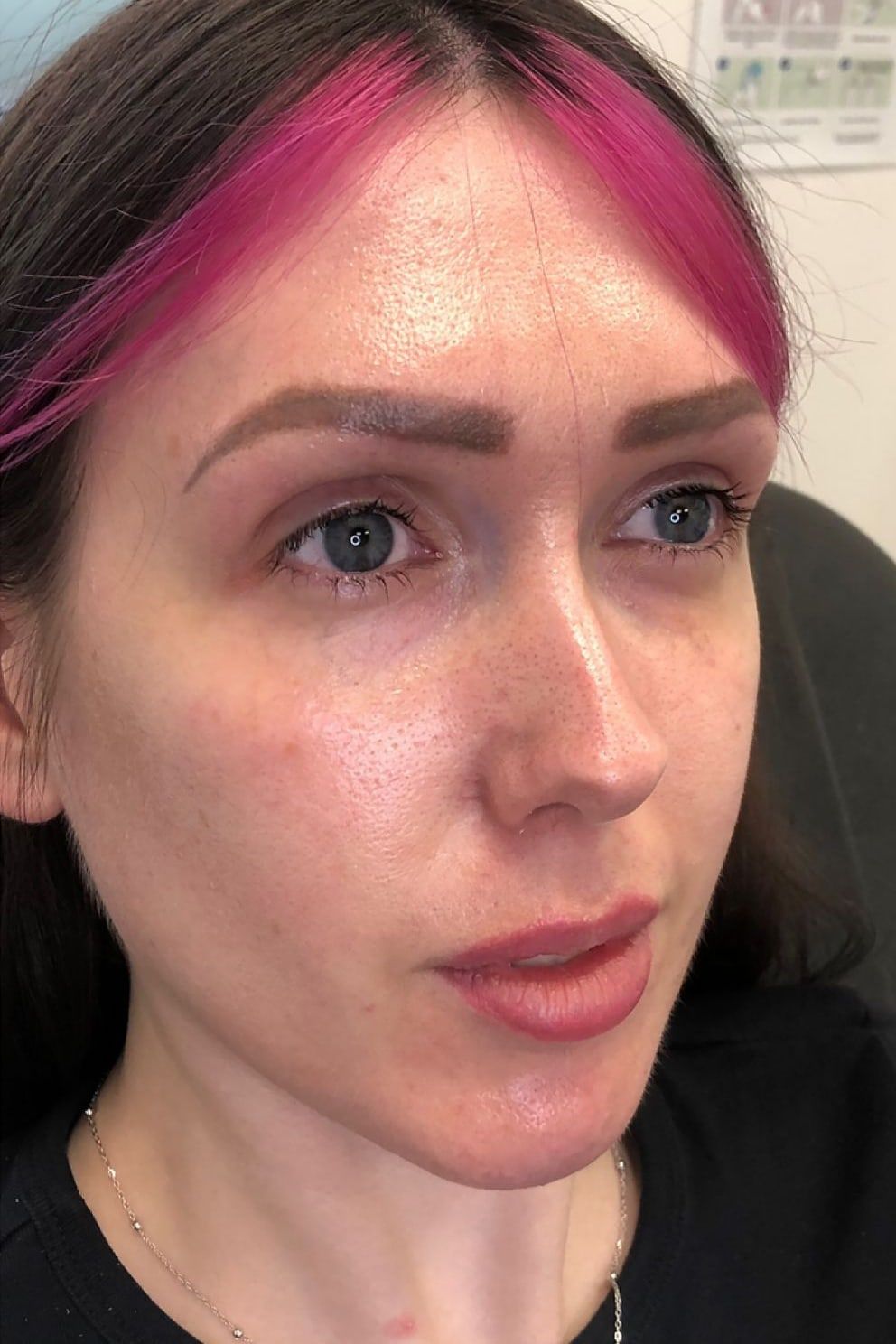Dermal filler: before treatment