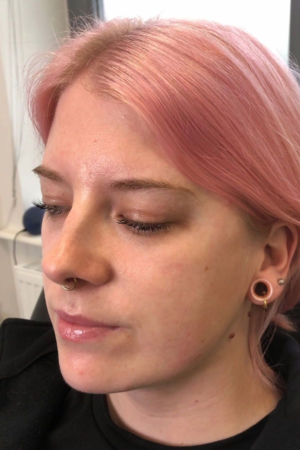 Dermal filler: before treatment