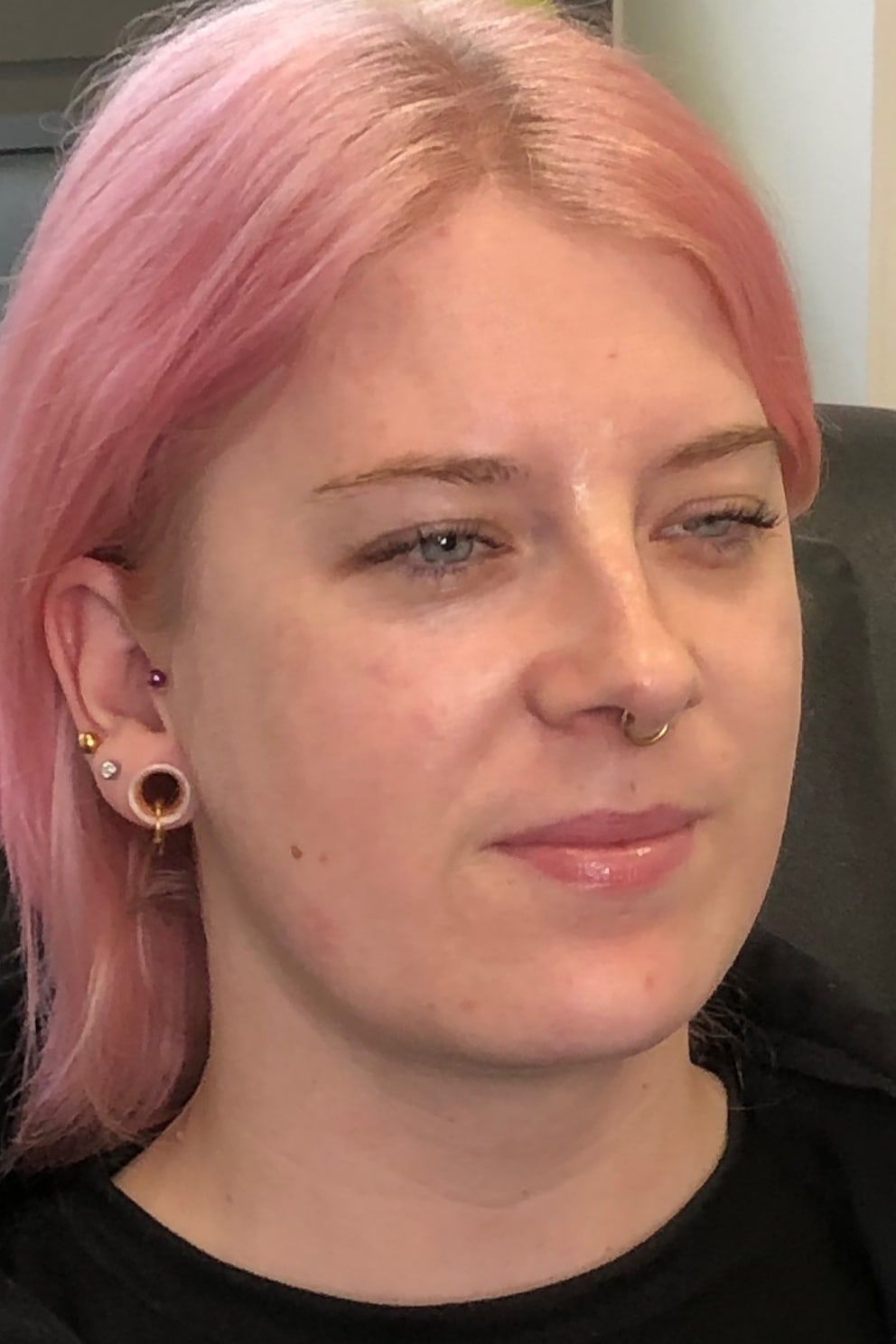 Dermal filler: before treatment