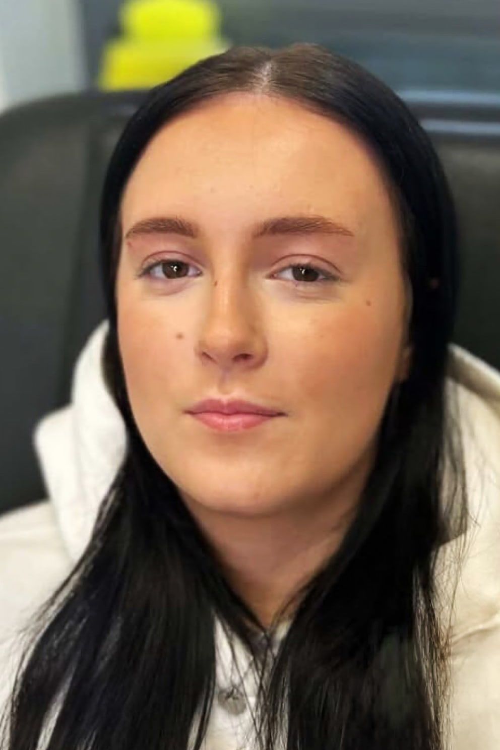 First-time lip filler: before treatment