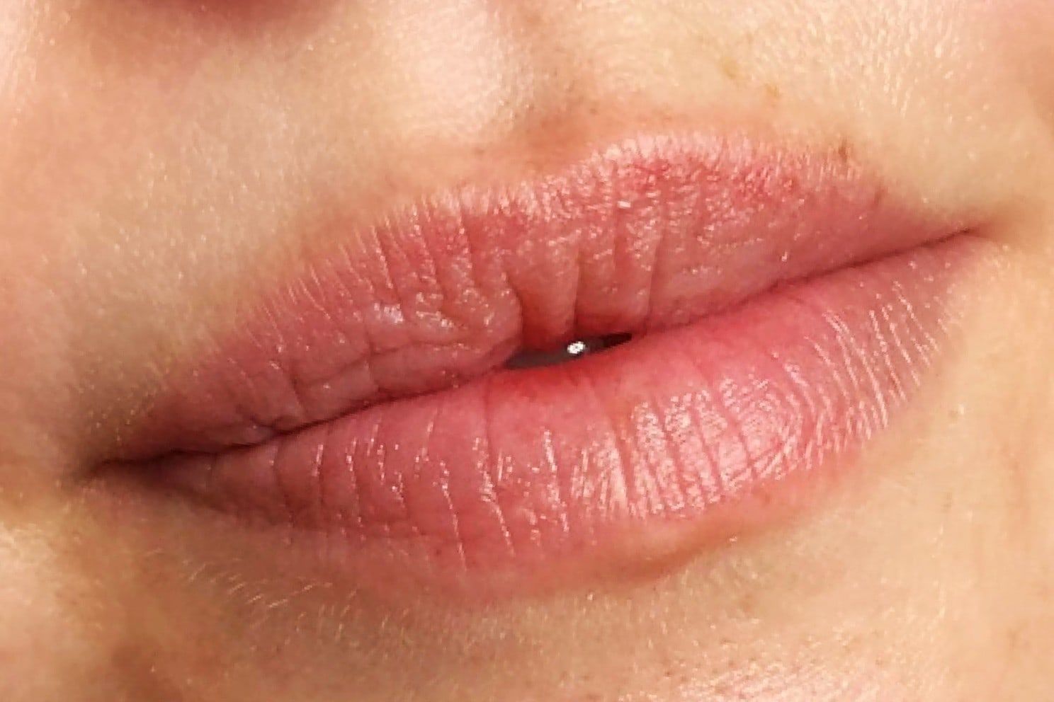 Lip filler: before treatment