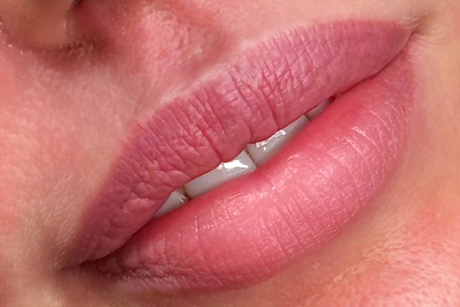 Lip filler: before treatment