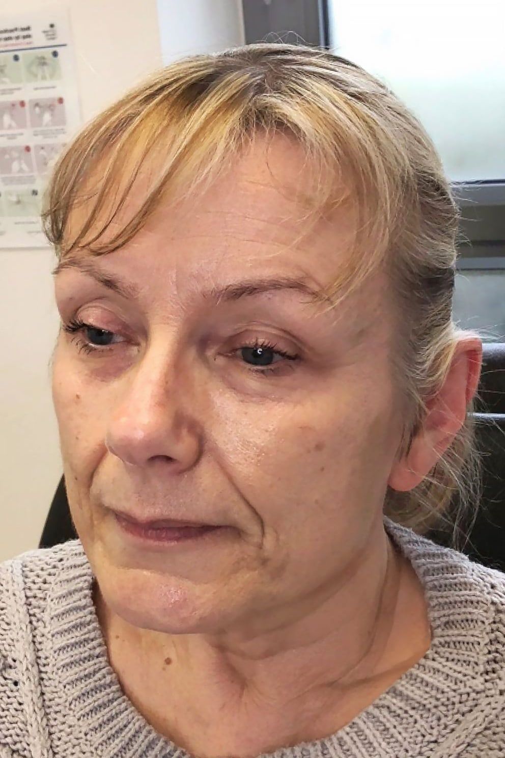 Mid-face filler: before treatment