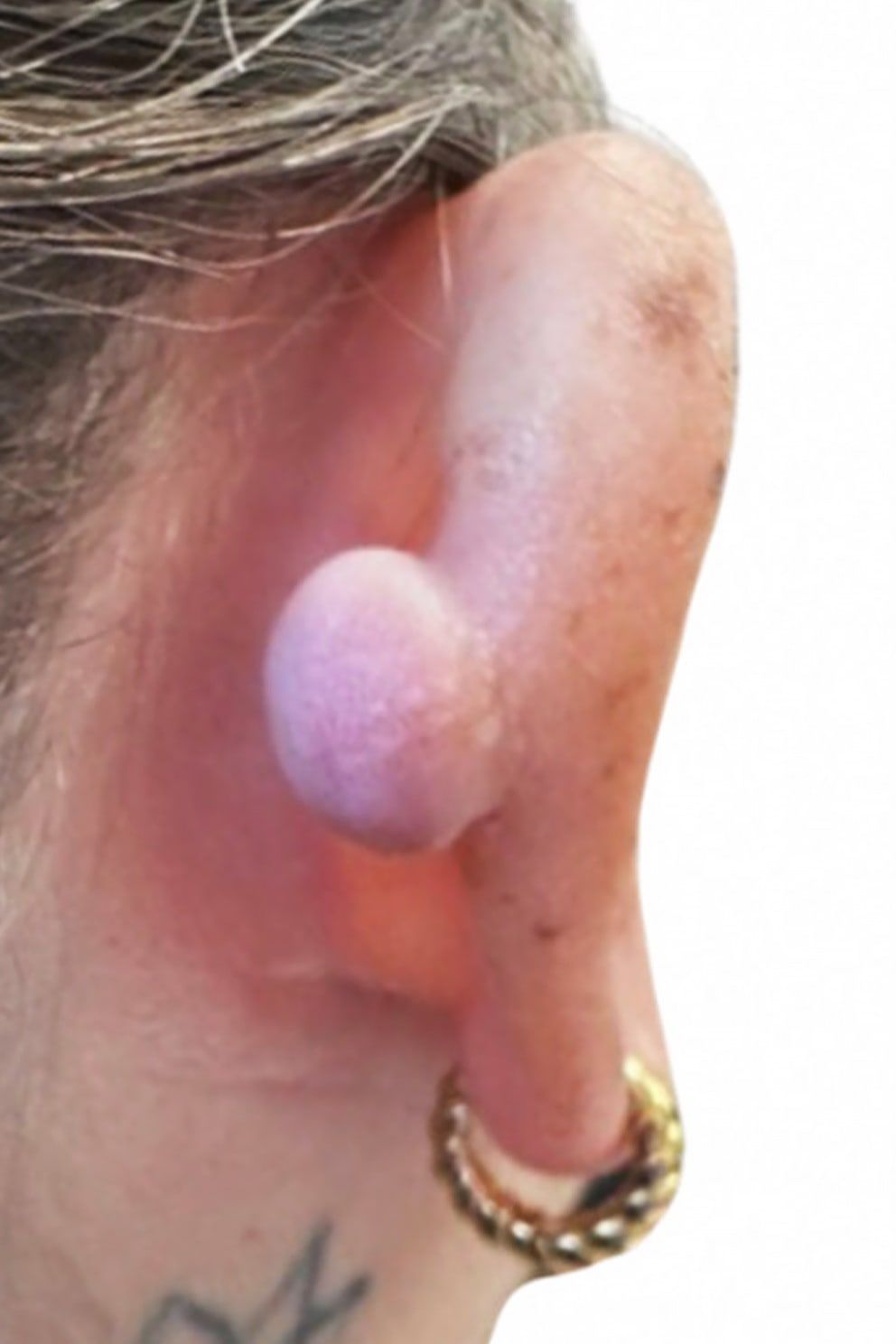 Minor surgery — lump removal: before treatment