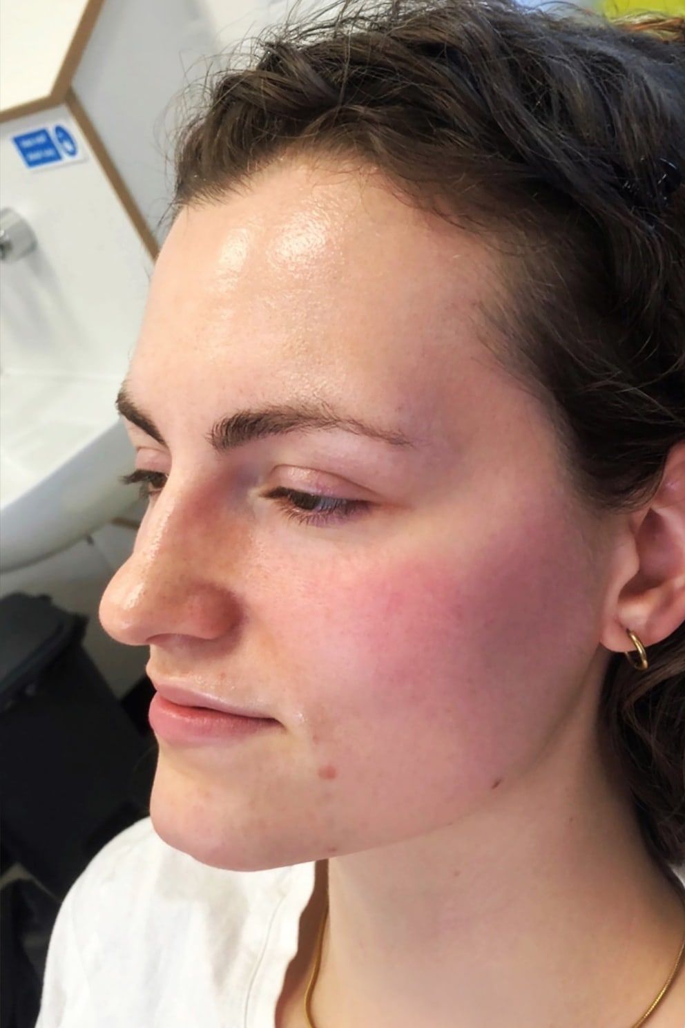 Non-surgical rhinoplasty: before treatment