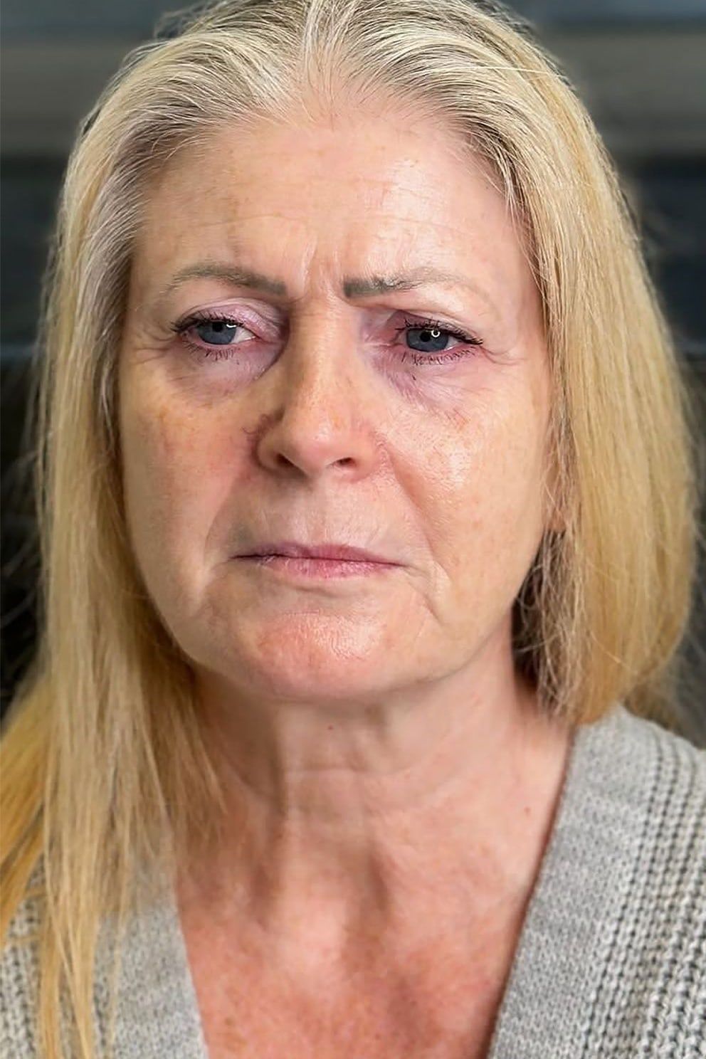 Ultimate 10 package: before treatment